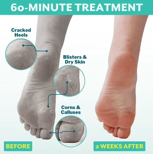 POSHPEEL Pedi Cure